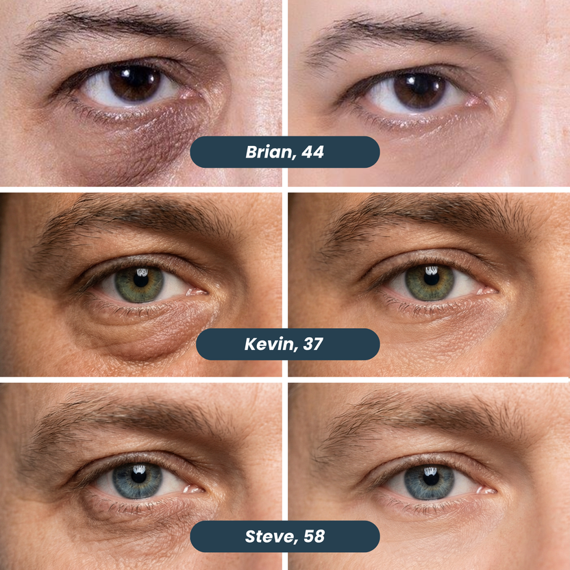 Under-Eye Microneedle Patches for Men